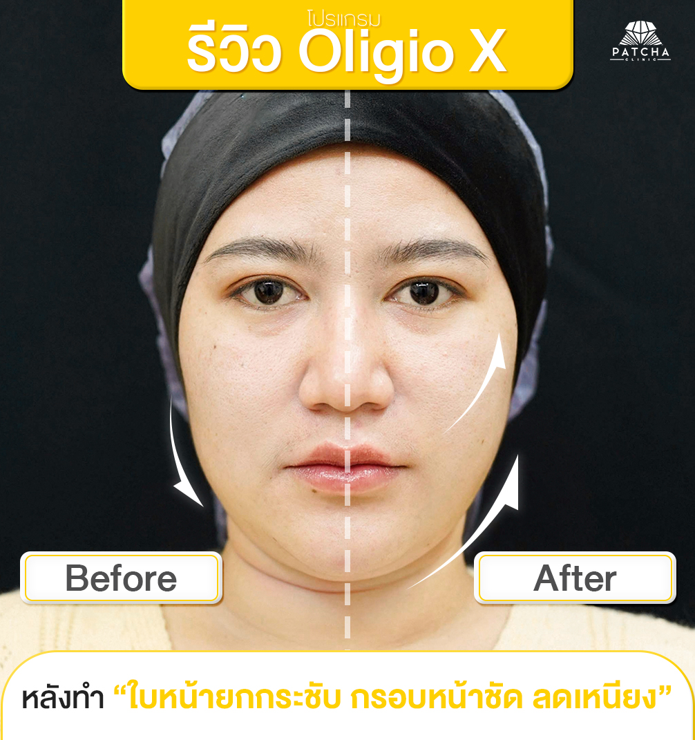 รีวิว Oligio X