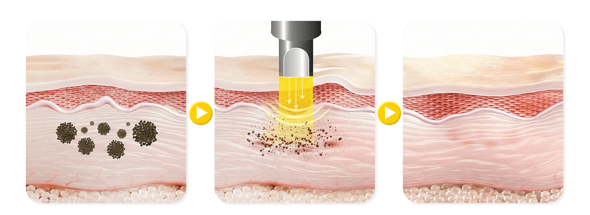 หลักการทำงาน Pico Laser