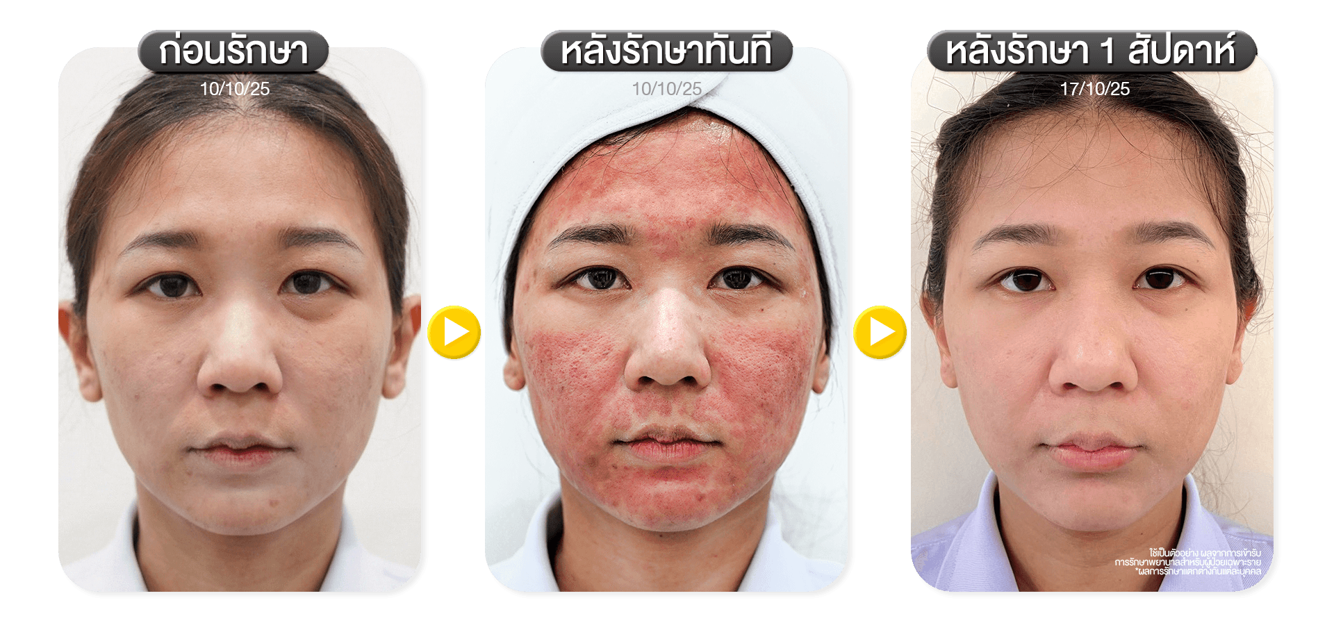 รีวิวรักษา Pico Laser