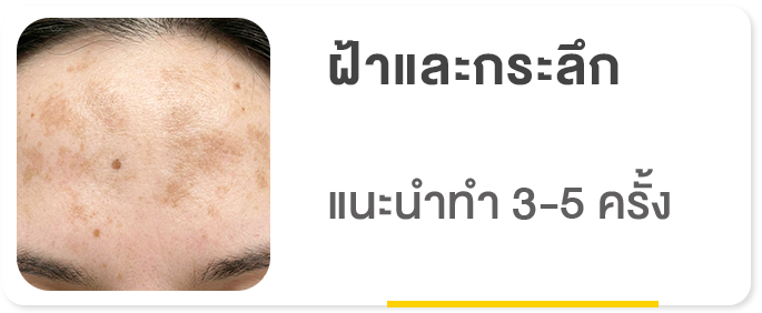 Pico Laser ลดฝ้าและกระลึก