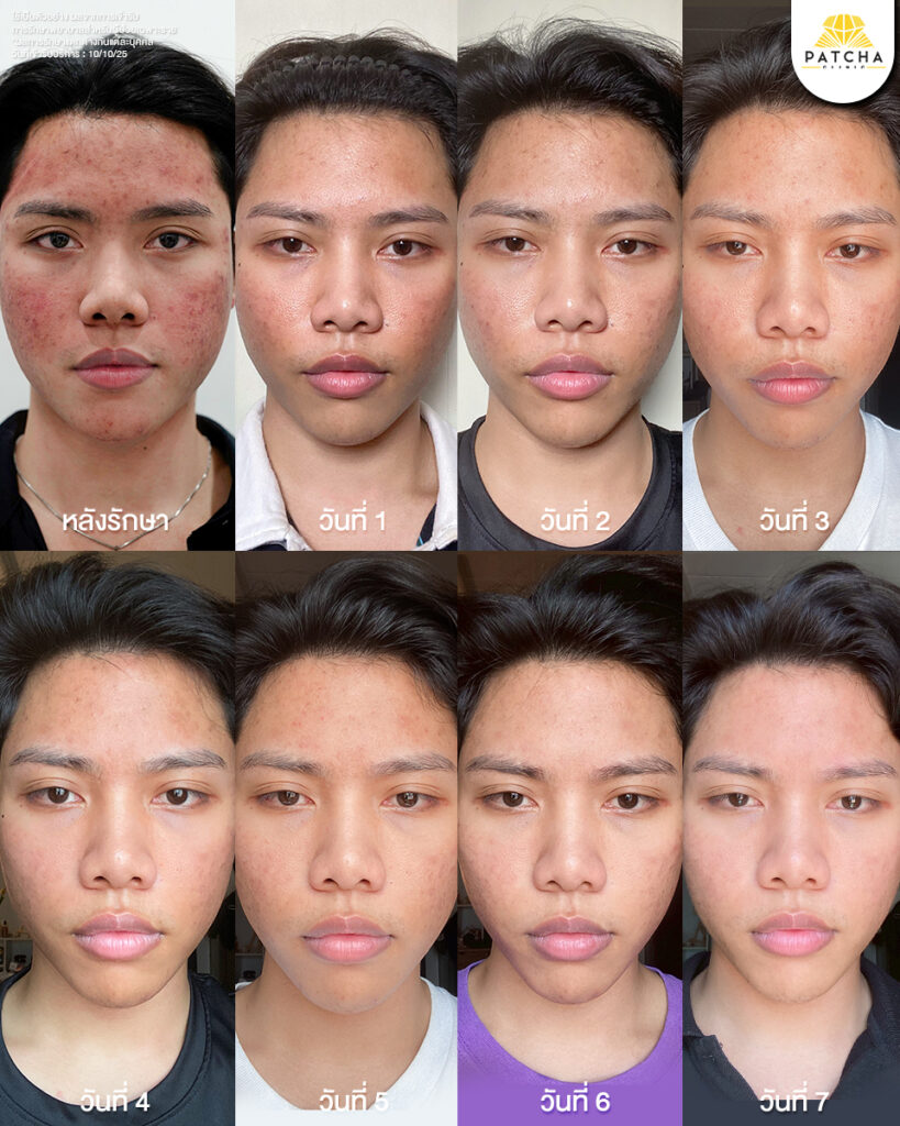 Pico Laser รีวิว3