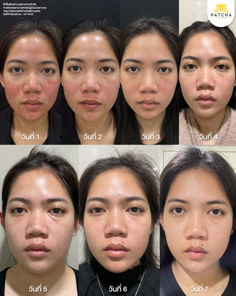 Pico Laser รีวิว4