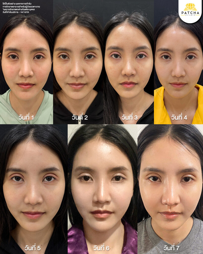 Pico Laser รีวิว6