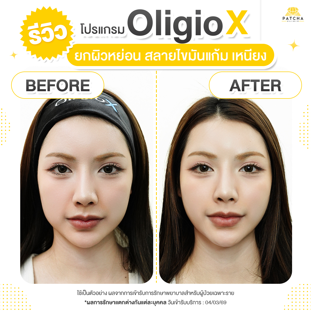 รีวิวOligio X