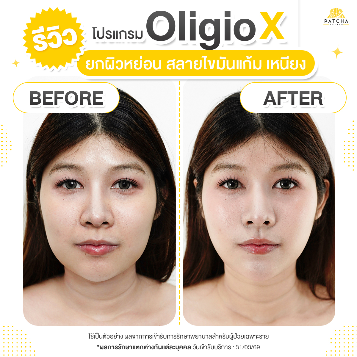 รีวิวOligio X